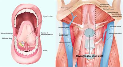 Endoscopic-Assisted Transoral Thyroglossal Cyst Resection